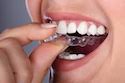 Clear Invisalign Braces