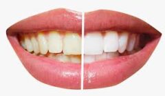 Smile Makeovers