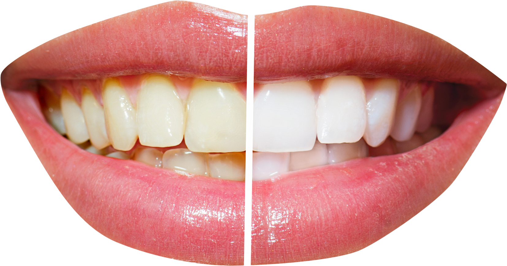 teeth whitening home and laser and zoom