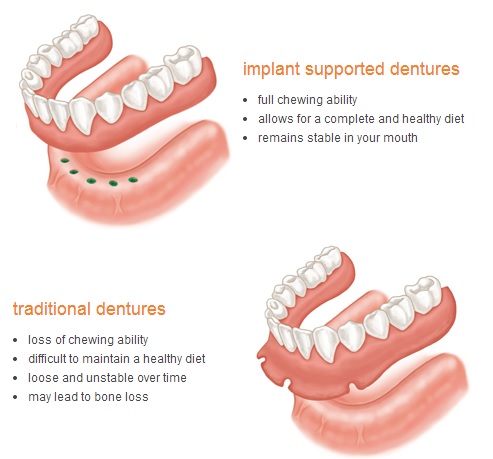 Implant-Denture