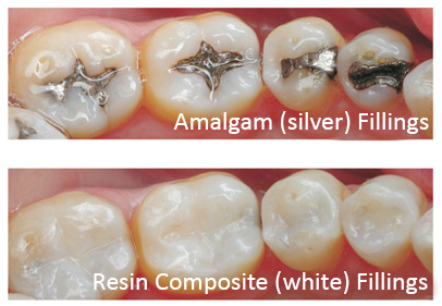 2 White Fillings 1
