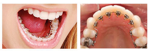 Lingual-Braces