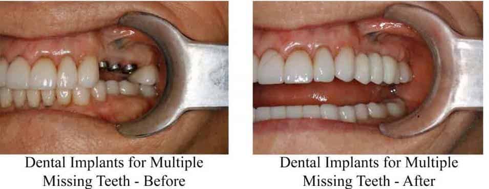 Multiple Dental Implants Before-And-And-After
