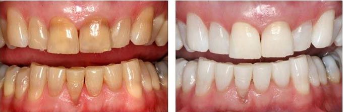 Home Teeth Whitening
