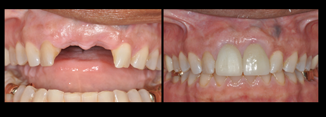 Multiple Dental Implants