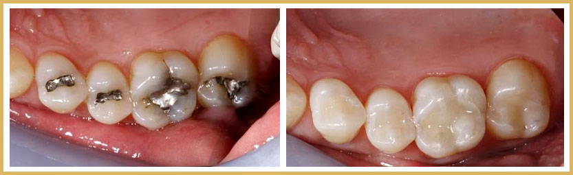 Safe-Mercury-Removal