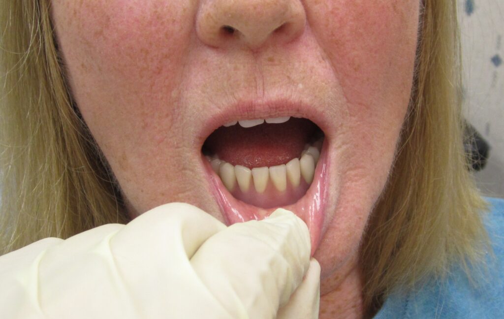 Denture-Implants