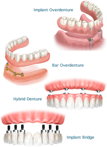 Multiple Dental Implants Before-And-And-After