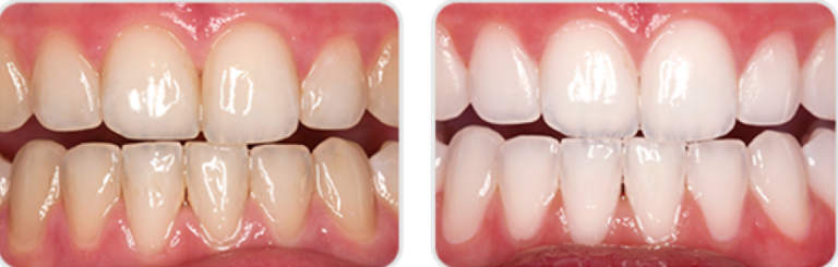 Home Teeth Whitening