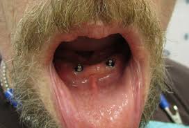 Denture-Implants