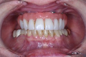 Denture-Implants