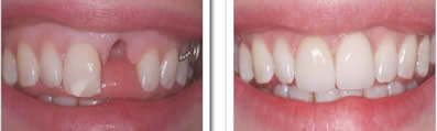 Dental Implants