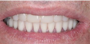 Dentures Supported Implants