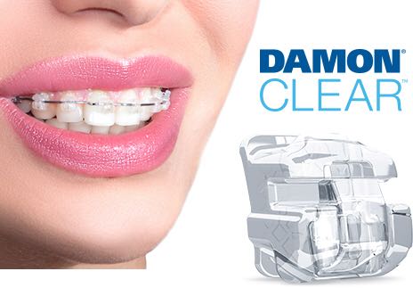 Damon Braces