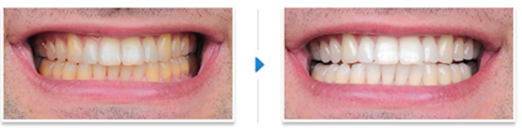 Laser-Teeth-Whitening