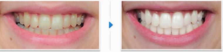 Laser-Teeth-Whitening