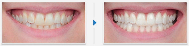 Laser-Teeth-Whitening