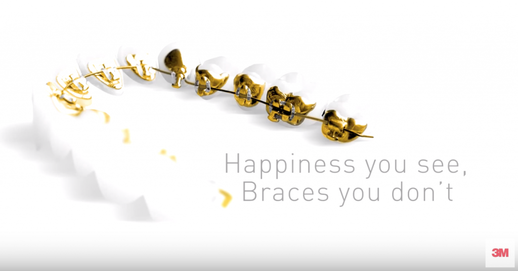 Lingual-Braces