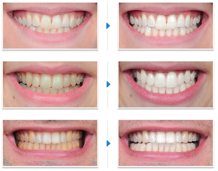 Teeth-Whitening