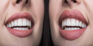 Botox