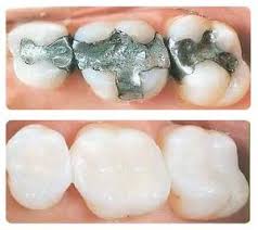 Amalgam-Removal-Safely
