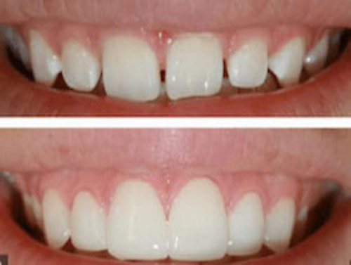 Smile Makeovers + Dental Makeover + Teeth Makeover