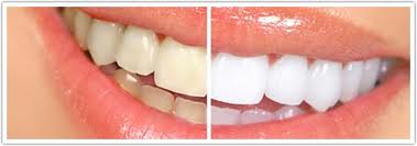 Laser-Teeth-Whitening