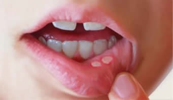 Aphthous Ulcers