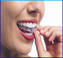 Invisalign