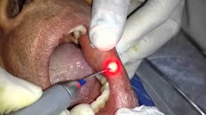 Aphthous Ulcers