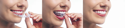 Invisalign-Braces