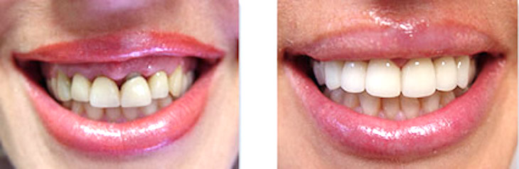 Emax-Veneers-Smile-Makeover