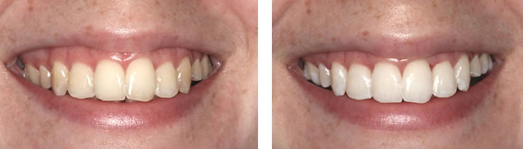 Laser-Teeth-Whitening