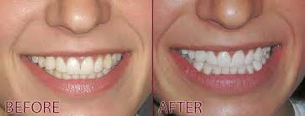 Teeth-Whitening-Laser