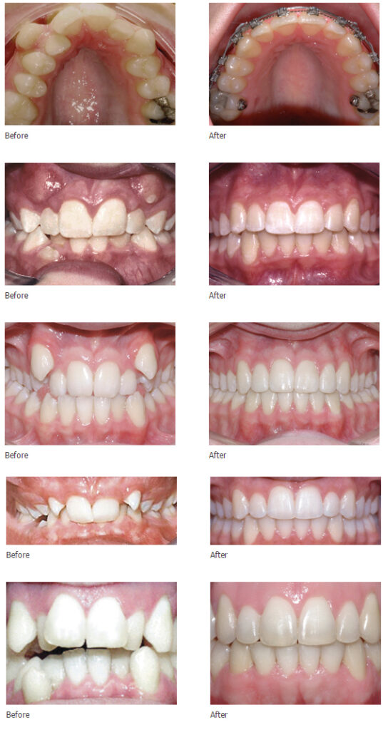 Damon Braces