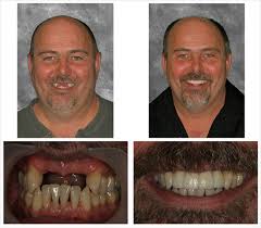 Dental Implants