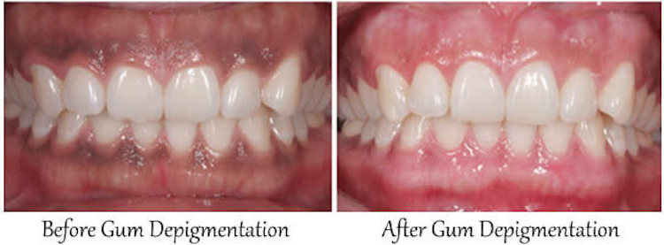 Gum Pigmentation
