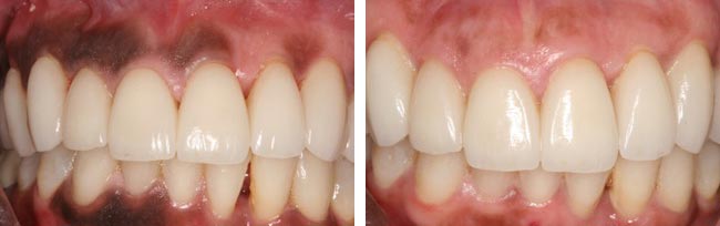 Gum Pigmentation