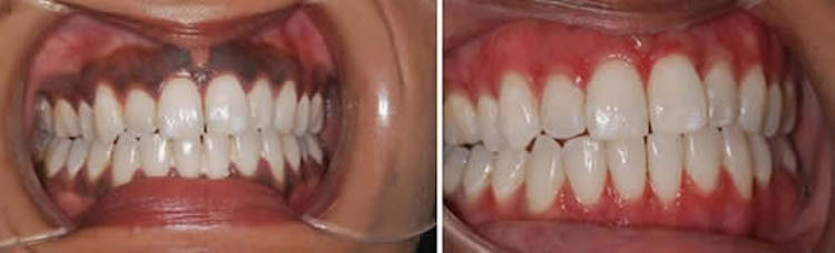 Gum Pigmentation