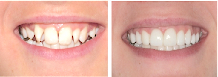 Smile Makeovers + Dental Makeover + Teeth Makeover