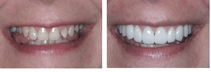 Smile Makeovers + Dental Makeover + Teeth Makeover