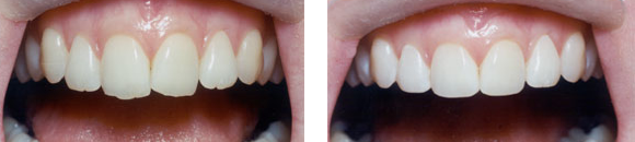Tooth-Recountouring