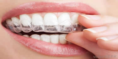 Home Teeth Whitening