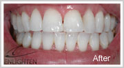 Enlighten-Teeth-Whitening