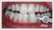 Enlighten-Teeth-Whitening