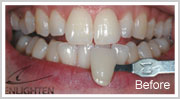 Enlighten-Teeth-Whitening