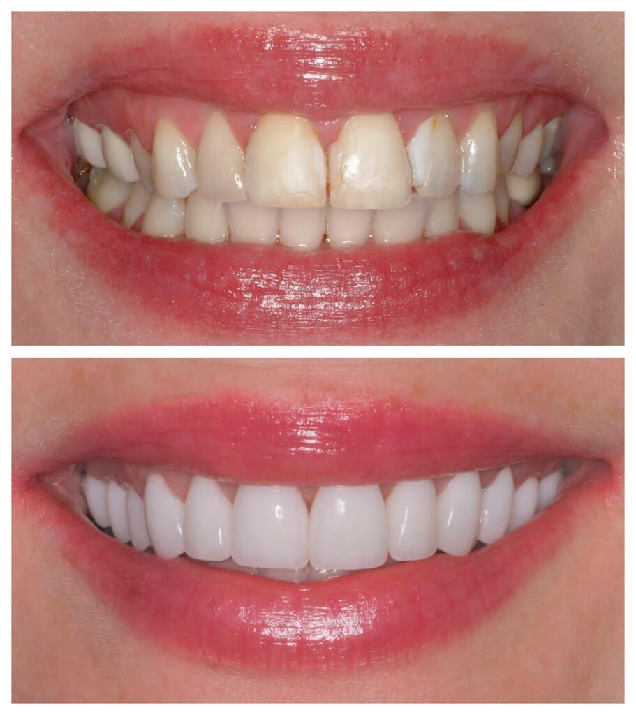 Veneers