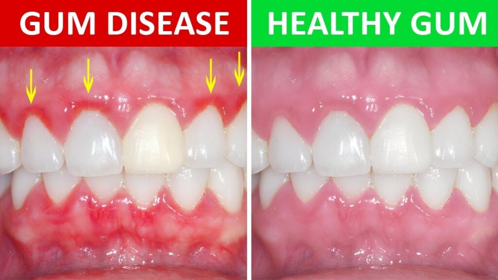 Gum-Disease-Health-Lasers