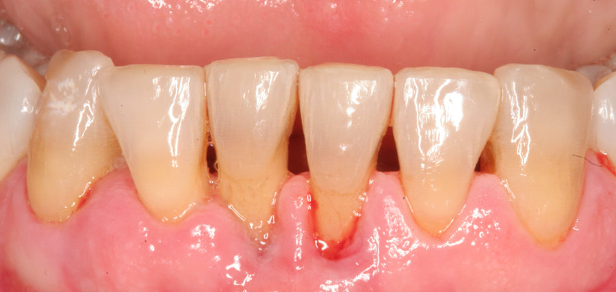 Gum-Disease-Health-Lasers