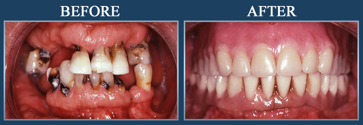 Gum-Disease-Health-Lasers